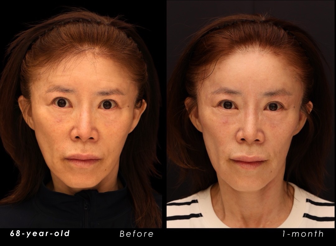 Frontal views of a 68-year-old endoscopic forehead lift patient, before surgery on the left and one month after surgery on the right