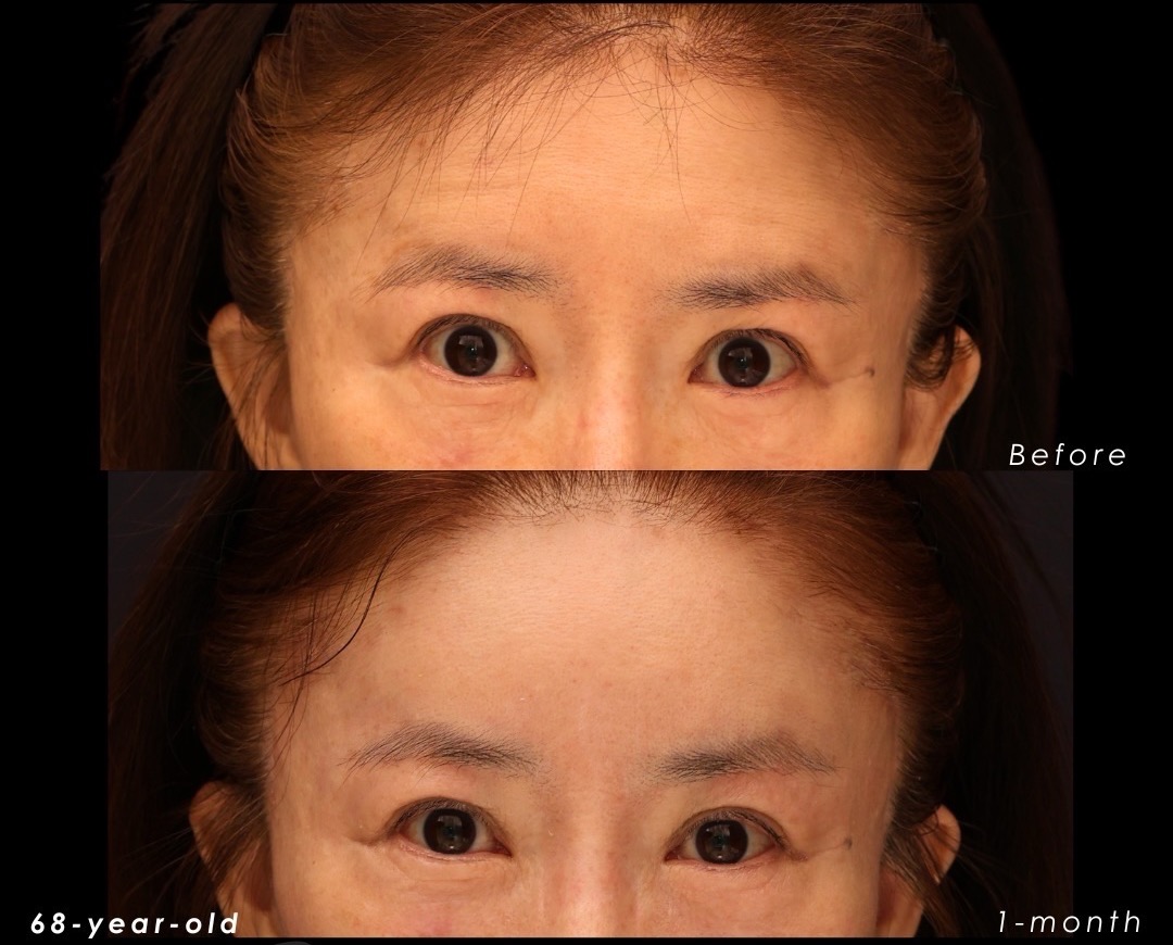 Close-up upper-face views of a 68-year-old endoscopic forehead lift patient, before surgery above and one month after surgery below
