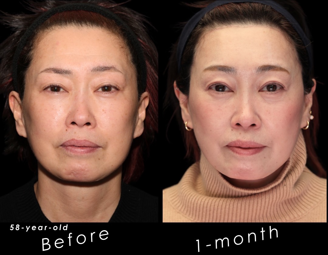 58歳女性の前額リフトと筋肉処理症例。正面の術前と術後1か月の比較