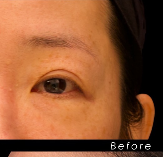 Preoperative view of a 44-year-old short-incision temporal lift patient