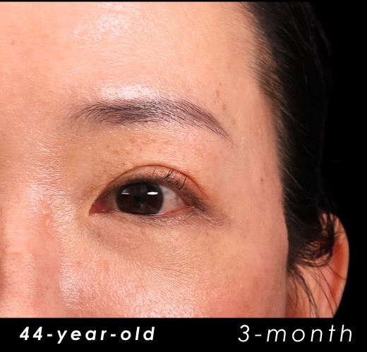 Three-month postoperative view of a 44-year-old short-incision temporal lift patient